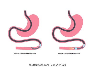 Double and single balloon enteroscopy minimally invasive procedure. Visualization of the small intestine. Biopsy, polyp removal, bleeding therapy or stent placement in gastrointestinal tract .poster.