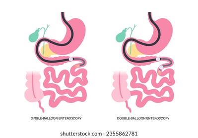 Double and single balloon enteroscopy minimally invasive procedure. Visualization of the small intestine. Biopsy, polyp removal, bleeding therapy or stent placement in gastrointestinal tract .poster.