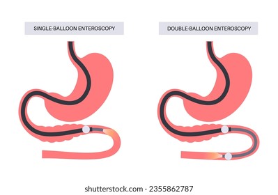 Double and single balloon enteroscopy minimally invasive procedure. Visualization of the small intestine. Biopsy, polyp removal, bleeding therapy or stent placement in gastrointestinal tract .poster.