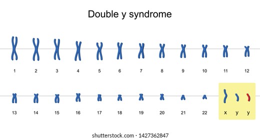 Double y syndrome karyotype, Nondisjunction of sex chromosomes, XYY