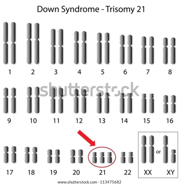 Down Syndrome Karyotype Stock Vector Royalty Free 113475682 4235