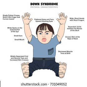 Down Syndrome Physical Characteristics infographic diagram showing affected kid born with this disability for medical science health care and people awareness