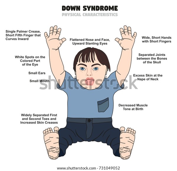 Down Syndrome Physical Characteristics Infographic Diagram стоковая