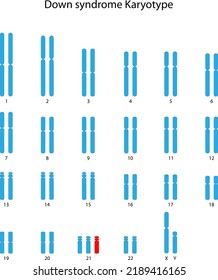 Down Syndrome (trisomy 21) Human Karyotype