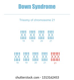 Down Syndrome. Trisomy of chromosome 21.Vector illustration.