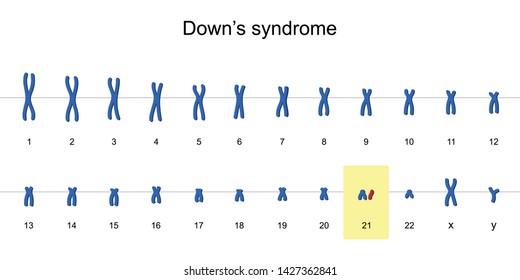 Down's syndrome karyotype, Autosomal abnormalities, Trisomy 21, vector illustration eps10