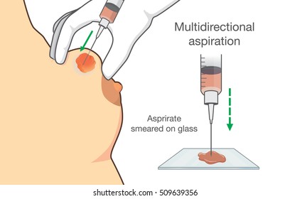 Drainage of breast cyst with needle for find breast cancer from sample. Illustration about breast cancer disease.