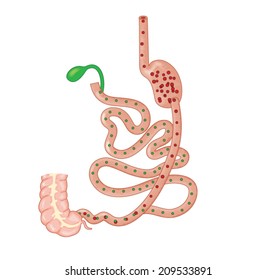 Drawing of bariatric surgery, showing a duodenal switch operation where a small gastric pouch is connected to the large intestine via the duodenum