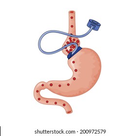 Drawing of bariatric surgery, showing a gastric band placed at the head of the stomach