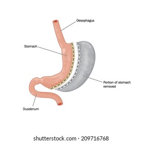 Drawing of bariatric surgery, showing half the stomach removed and the remaining stomach stapled, resulting in a reduction in gastric volume (labelled)