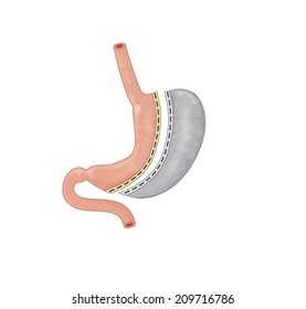 Drawing of bariatric surgery, showing half the stomach removed and the remaining stomach stapled, resulting in a reduction in gastric volume