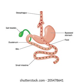 Drawing of bariatric surgery, showing a Roux-en-Y gastric bypass operation (RYGB) where food is diverted from the oesophagus directly to the small intestine