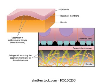 Drawing Of Blister Formation In Skin Disease Such As Epidermolysis Bullosa, Where The Epidermis Separates From The Basement Membrane And Dermis