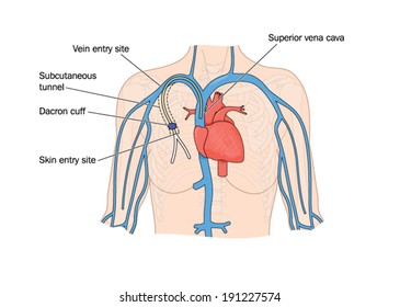 Drawing of catheter insertion into heart -- labelled