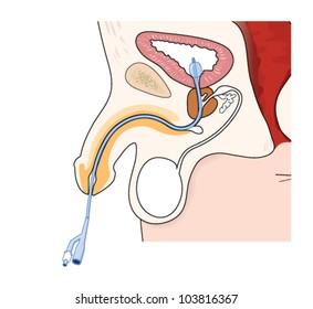 Drawing of a catheter in a male, showing the position of the catheter in the urethra and bladder, with an inflated balloon