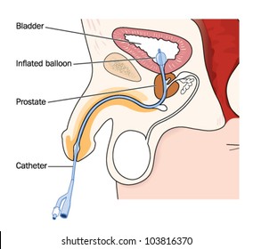 Drawing of a catheter in a male, showing the position of the catheter in the urethra and bladder, with an inflated balloon
