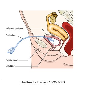 Drawing of a catheter placed through the abdominal wall into the female bladder (suprapubic)