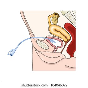 Drawing of a catheter placed through the abdominal wall into the female bladder (suprapubic)