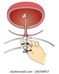 Drawing of doctor using a cystoscope to investigate bladder cancer. Created in Adobe Illustrator.  Contains linear and radial gradients.  EPS 10.