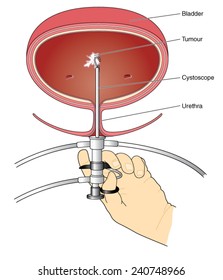 Drawing of doctor using a cystoscope to investigate bladder cancer. Created in Adobe Illustrator.  Contains linear and radial gradients.  EPS 10.