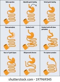 Drawing of gastric banding and gastric bypass operations -- labelled