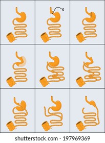 Drawing of gastric banding and gastric bypass operations