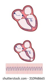 Drawing Of Heart Electrical Conducting System, The Site Of Ventricular Tachycardia And The Resulting Ecg Trace