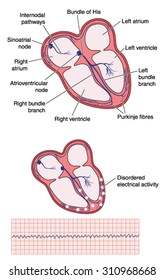 Drawing Of Heart Electrical Conducting System, The Site Of Ventricular Fibrillation Disordered Electrical Activity And The Resulting Ecg Trace.