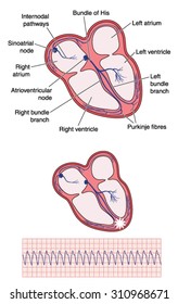 Drawing Of Heart Electrical Conducting System, The Site Of Ventricular Tachycardia And The Resulting Ecg Trace