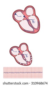 Drawing Of Heart Electrical Conducting System, The Site Of Ventricular Fibrillation Disordered Electrical Activity And The Resulting Ecg Trace.