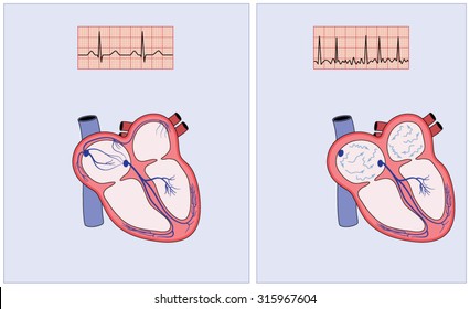 Drawing Of The Heart Electrical Conduction System Showing Normal Activity And Erratic Impulses In Atrial Fibrillation.