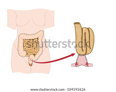 Drawing of an ileo-rectal pouch made from ileum following bowel removal