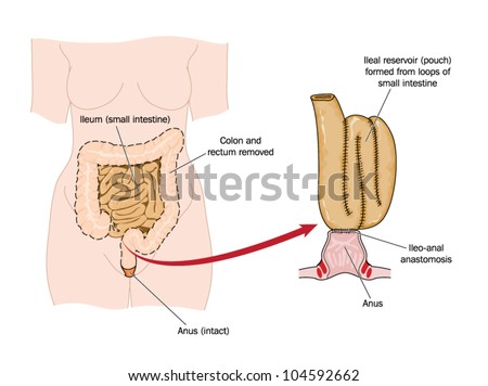 Drawing of an ileo-rectal pouch made from ileum following bowel removal