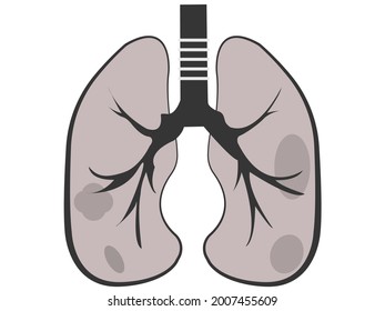 Dibujo de pulmones de algún tipo de enfermedad, como cáncer o enfisema