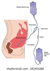 Drawing to show peritoneal dialysis, with PD catheter inserted into peritoneal cavity and attached to solution and waste bags. Created in Adobe Illustrator.  EPS 10.