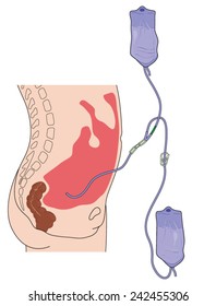 Drawing to show peritoneal dialysis, with PD catheter inserted into peritoneal cavity and attached to solution and waste bags. Created in Adobe Illustrator.  EPS 10.