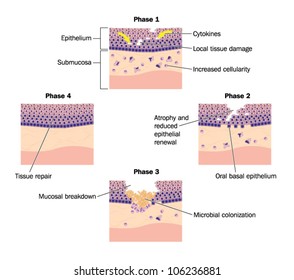 Drawing To Show Phases Of Tissue Repair, Specifically Oral Mucosal Tissue