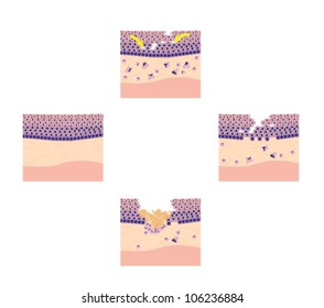 Drawing To Show Phases Of Tissue Repair, Specifically Oral Mucosal Tissue