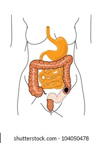 Drawing to show the position of a stoma after an end colostomy following the removal of the sigmoid colon