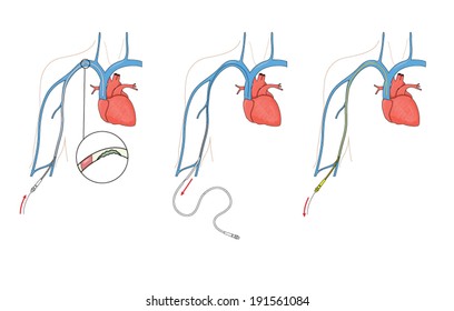 Drawing to show replacement of a damaged peripherally inserted central catheter (PICC)