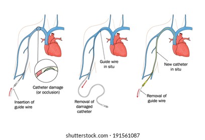 Drawing to show replacement of a damaged peripherally inserted central catheter (PICC) -- labelled