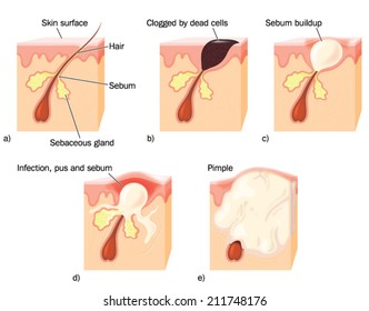 Drawing to show the stages of pimple formation, showing a clogged hair duct, sebum build up, infection and pus formation.