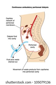 Drawing to show the technique of peritoneal dialysis, where dialysis fluid is placed in and then removed from the peritoneal cavity for the removal of waste materials