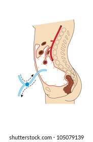 Dibujo para mostrar la técnica de diálisis peritoneal, donde se coloca el líquido diálisis y luego se elimina de la cavidad peritoneal para la eliminación de los materiales de desecho