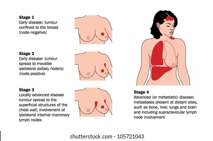 Drawing to show the various stages of breast cancer, from early onset disease through local spread to advanced metastatic disease