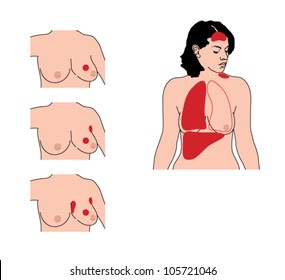 Drawing to show the various stages of breast cancer, from early onset disease through local spread to advanced metastatic disease