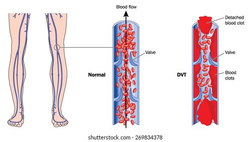 Drawing showing deep vein thrombosis in leg veins. Created in Adobe Illustrator.  EPS 10.