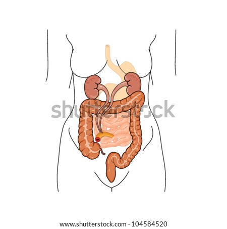 Drawing of a typical urostomy, where a small piece of ileum is used to redirect urine to the abdominal wall, following bladder surgery or obstruction