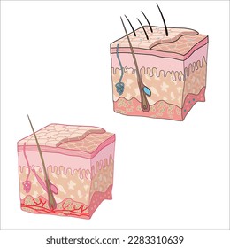 Drawings of normal and inflammatory skin structures for study.