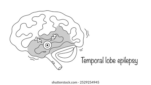 Gezeichnetes Gehirn mit hervorgehobenem Temporallappen. Epilepsie des Temporallappens. Eine Form der Epilepsie, gekennzeichnet durch Krampfanfälle mit Lokalisierung des epileptogenen Fokus im Temporallappen des Gehirns.